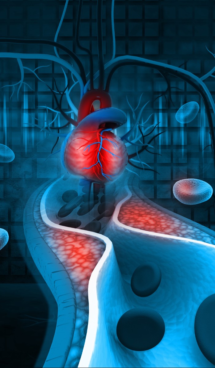 Illustration einer verstopften Arterie mit Cholesterinablagerungen, die zu Arteriosklerose führen. Zu sehen sind Ansammlungen von Cholesterin, die den Blutfluss behindern und das Risiko für Herz-Kreislauf-Erkrankungen erhöhen.